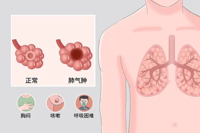 肺气肿3个症状01.jpg